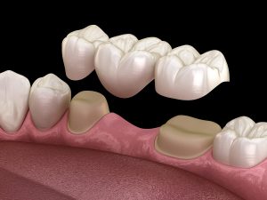 Dental Bridge vs Dental Implants