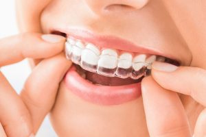 Invisible aligners for teeth