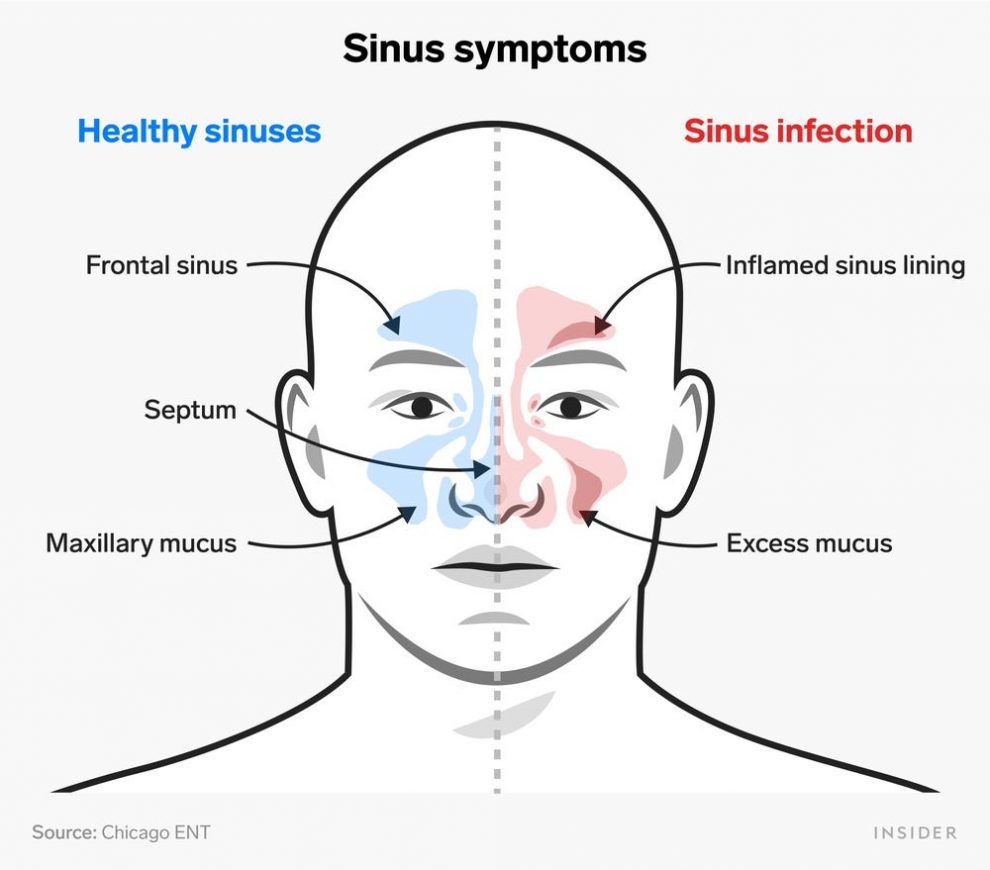 Home remedies for Sinusitis