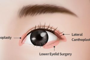 Epicanthoplasty and Lateral canthoplasty