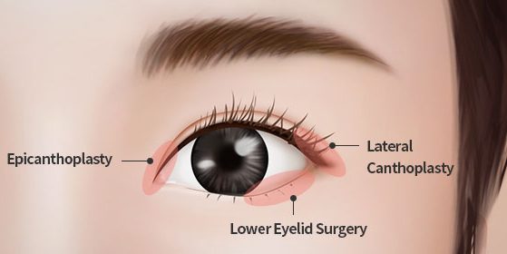 Epicanthoplasty and Lateral canthoplasty