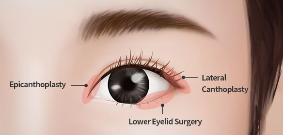 Epicanthoplasty and Lateral canthoplasty