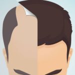 The Essential Aspects To Know About A Hair Transplant Process