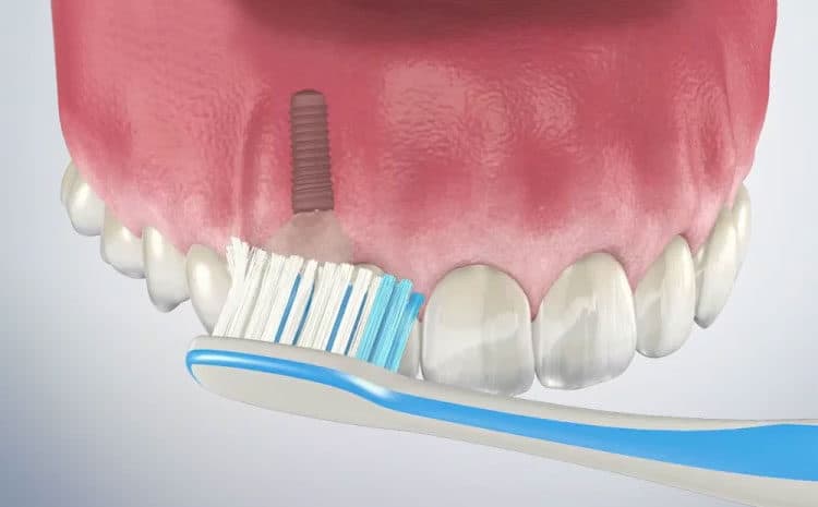 Dental Implant Care