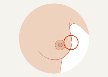 Breast Dimpling