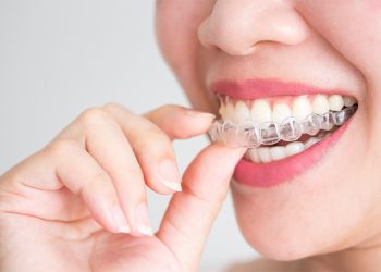 Demystifying Invisalign: Nine vital things you should know as a potential patient