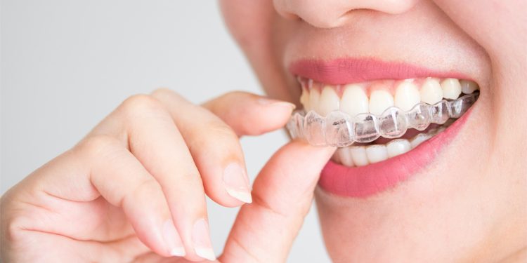 Demystifying Invisalign: Nine vital things you should know as a potential patient