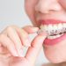 Demystifying Invisalign: Nine vital things you should know as a potential patient