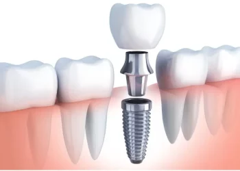 Dental Implants