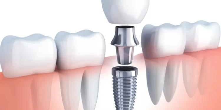 Dental Implants