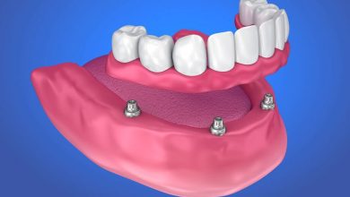 Dental Implants vs. Dentures