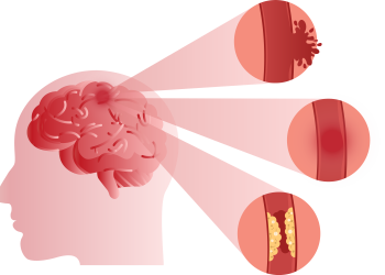 First Aid for Stroke Victims