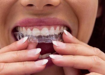 Getting invisible braces in Clapham