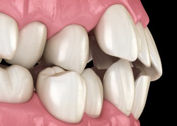 Misaligned Teeth