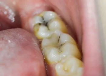 Stop a Cavity From Growing