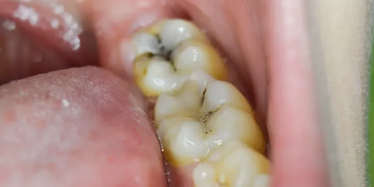 Stop a Cavity From Growing
