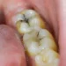 Stop a Cavity From Growing