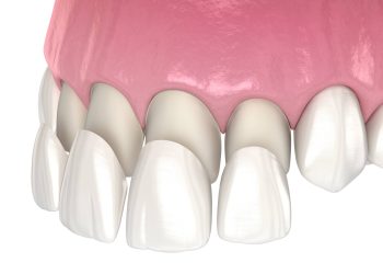 What are porcelain veneers and should I get them