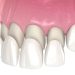 What are porcelain veneers and should I get them