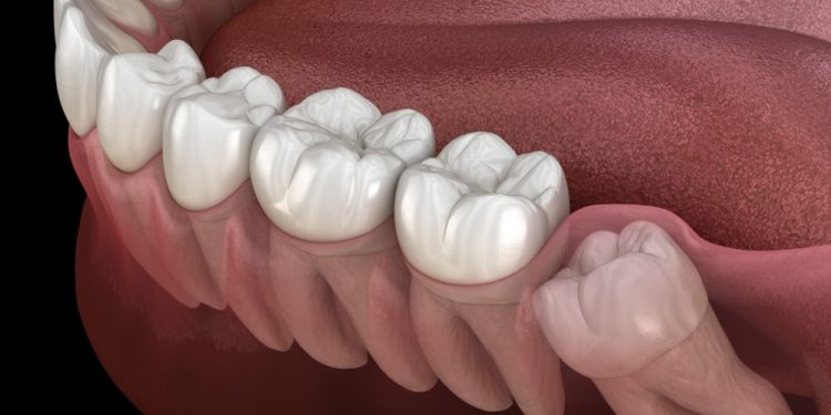 Wisdom teeth Gordon are the last set of adult teeth to erupt, and they are located at the very back of your mouth. Wisdom teeth usually come through between the ages of 18 and 24. They are called wisdom teeth simply because we are thought to be “wiser” in our adult years. Statistics show that about 53% of the population have at least one wisdom tooth, whilst some people never develop wisdom teeth at all. If you do not have any wisdom teeth, don’t worry; they are thought to be vestigial, meaning they served a purpose at one point for our ancestors who ate a lot of raw, fibrous and hard foods, but we do not need them any more because our diets consist of cooked and softer foods. It is assumed that wisdom teeth mean trouble; however, this is not always the case. If they emerge normally and there is sufficient space in your mouth, wisdom teeth should be no trouble at all. Unfortunately, sometimes these teeth are unable to emerge normally because the jaw is too small for any more teeth; this is when problems begin. If the wisdom tooth emerges at an angle, it can put pressure on the gums and adjacent teeth, causing pain and discomfort. This pain may go away by itself or with the help of painkillers. Unfortunately, if the pain is severe or the wisdom tooth causes issues like infections, cysts, tumours, tooth decay or damage to the adjacent teeth, you may need to extract it. Wisdom teeth extraction The removal of wisdom teeth is one of the most common surgical procedures. This procedure is typically carried out under local anaesthesia or sedation, and for more complex cases, it can be done under general anaesthesia in a hospital. If the surgery is necessary, it should be done as soon as possible to avoid complications later on. Conventional tooth extraction is quite simple. You will be given local anaesthesia, which will eliminate any pain for your comfort and ease. If the tooth is fixed in place, the dentist will have to loosen it first using an elevator. They will then use a pair of forceps to pull the tooth out from the gums. If the tooth is already wobbly, then the process is a lot easier. Wisdom teeth extraction is more complicated. The dentist may have to make an incision in the gums to access the tooth easily, especially if it is impacted. The tooth may need to be broken up into smaller parts so that it can be removed. The process may take approximately 20 minutes, and you may require stitches if an incision has been made. The recovery can take up to 2 weeks, and you may be given antibiotics to prevent infections. You can revisit the dentist to make sure the process is coming along successfully or if you experience any issues. What if you don't remove your wisdom teeth? Not getting a problematic wisdom tooth removed can have a significant impact on your dental health as well as your overall health and well-being. To begin with, you may be in constant pain, which can affect your daily life and prevent you from going about your everyday activities. A wisdom tooth can cause your remaining teeth to become crooked and misaligned as it places pressure on them to make space for itself. Your teeth can become overcrowded, especially if you have wisdom teeth on either side of your jaw; this can increase the chance of tooth decay and gum disease. An impacted wisdom tooth can lead to a bacterial infection called pericoronitis. It can also lead to the development of a cyst or a tumour which can damage bone and gum tissue. Ask your dentist When you notice your wisdom teeth start growing, book an appointment with your dentist sooner rather than later, whether or not you are experiencing any problems. Your dentist will ensure your wisdom teeth are erupting correctly and that there is sufficient space for them to do so. If any issues are found, a treatment plan will be put together for you early on. Good dental hygiene and regular dental checkups will mean that you may be able to spot a wisdom tooth early on, and in this way, you can prevent any damage to your healthy teeth. Make sure you visit your dentist at least once every six months or more often where necessary to maintain healthy teeth and gums, and a beautiful, happy smile. Disclaimer What to do with your wisdom teeth