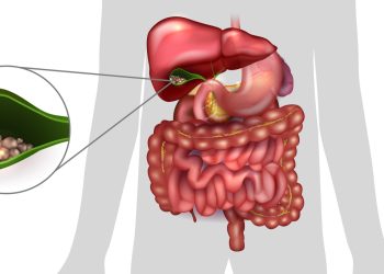 gallstones removal in Singapore