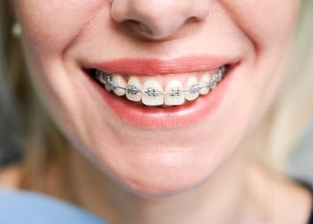 Adult Braces