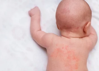 Child Eczema
