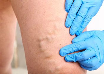 Varicose Veins