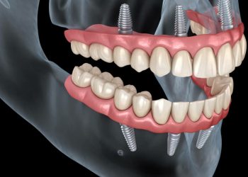 Dental Implants