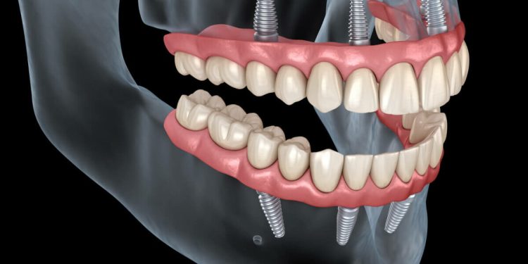 Dental Implants