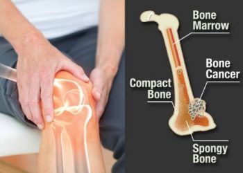 Bone tumor treatment by an orthopedic specialist