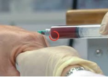 Platelet-Rich Plasma (PRP): A Comprehensive Overview