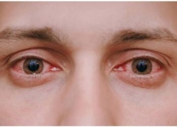 Do You Have Itchy Eyes? Learn What It Is and How to Care for Your Eyes!