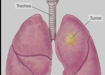 Understanding Lung Cancer: Causes, Types, and Risk Factors