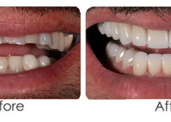 Teeth Reconstruction