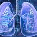 Managing Lung Issues