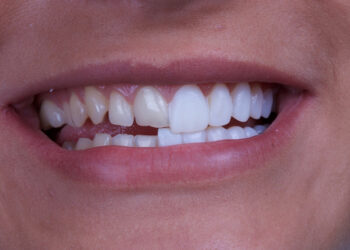 Porcelain Veneers