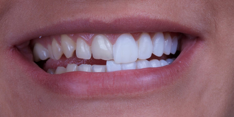 Porcelain Veneers