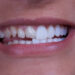 Porcelain Veneers