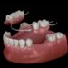 Understanding Full and Partial Dentures – Effective Solutions for Tooth Loss