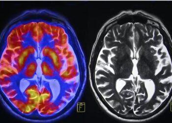 Chronic stress irreversibly changes our brain: symptoms and causes