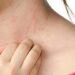 How Effective Are Cortisone-Free Psoriasis Creams For Immediate Relief? 