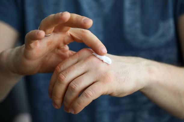 male hands applying moistening cream on skin - skin condition creams stockfoto's en -beelden