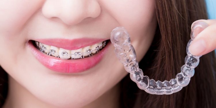 Invisalign and Braces