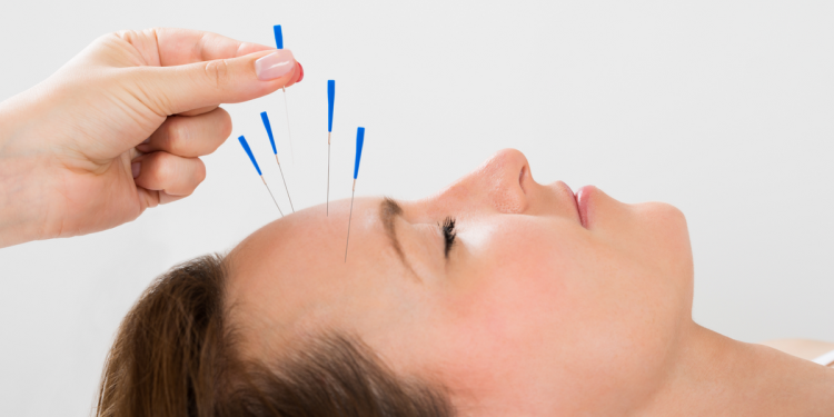 Acupuncture for Headaches