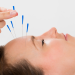 Acupuncture for Headaches