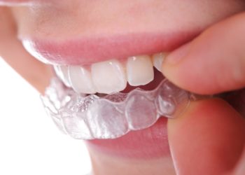 Dazzling Smile- The Ultimate Retainer Color Guide