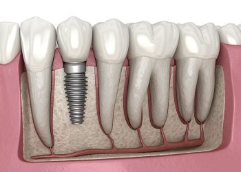Dental Implant
