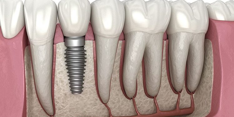 Dental Implant