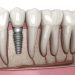 Dental Implant